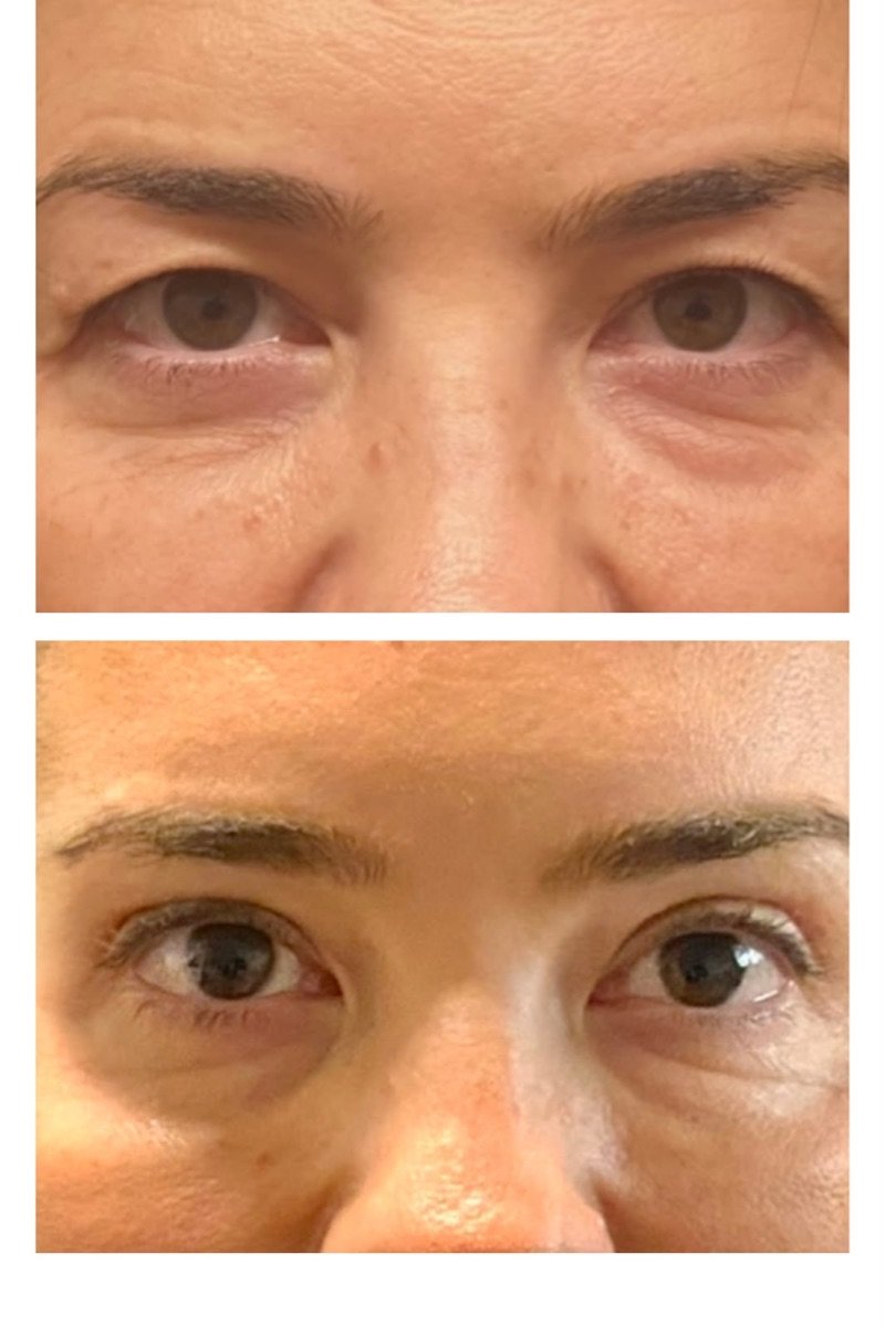 Résultats avant/après blépharoplastie – poches réduites et paupières lissées