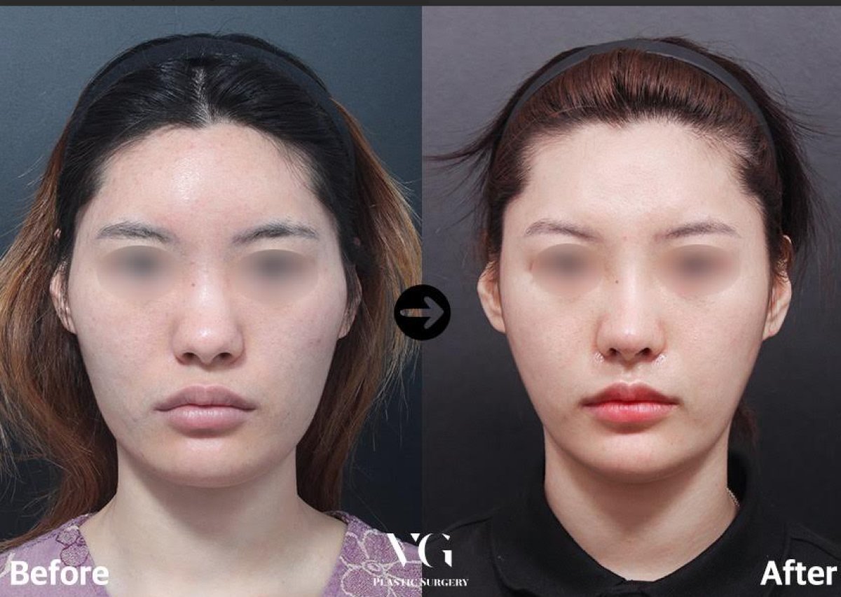Before and after face contouring results at VG Plastic Surgery – improved facial symmetry