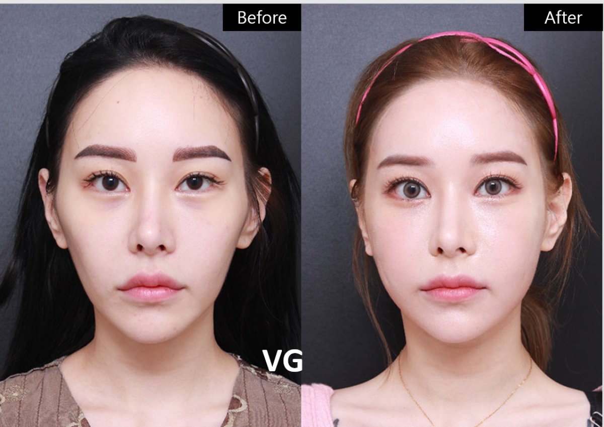 نتائج تحديد ملامح الوجه قبل وبعد في VG Plastic Surgery – تناظر وجهي محسّن