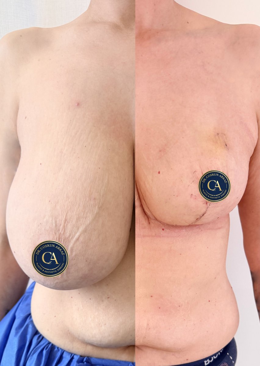 Before and after breast reduction results at Zarina Clinic – visible size and shape improvement