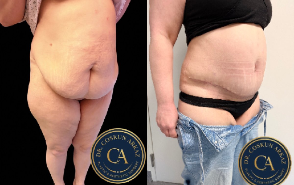 Before and after tummy tuck and liposuction results at Zarina Clinic, improved abdomen contour