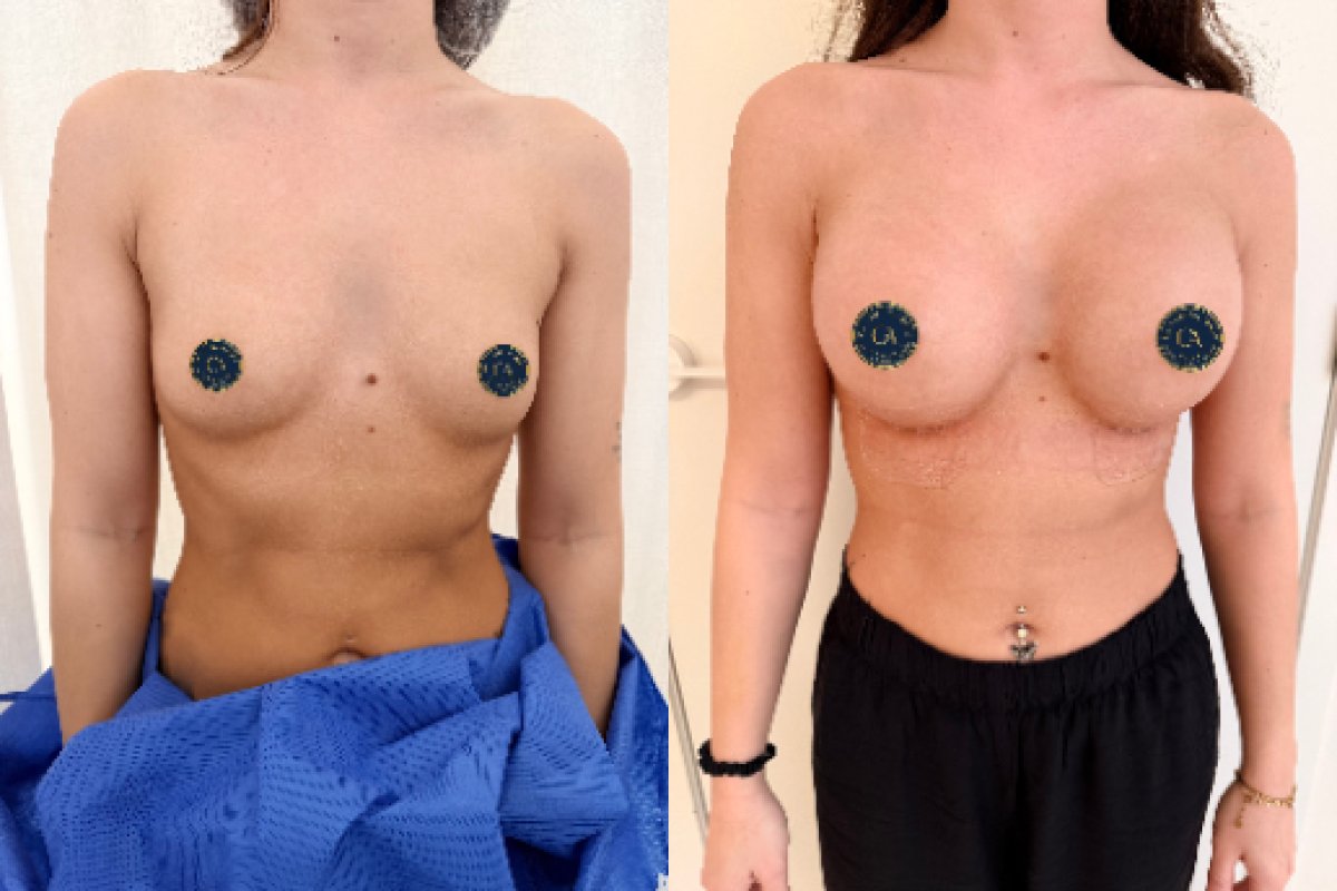 نتائج قبل وبعد تكبير الثدي في عيادة Zarina، تحسين شكل وحجم الثدي