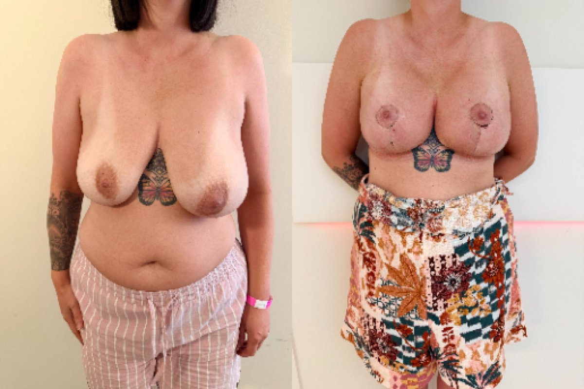 Before and after breast lift with implants at Zarina Clinic, round implant results shown