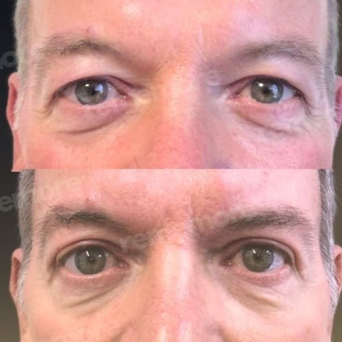 Before and after droopy eyelid surgery results at Memorial Bahçelievler Hospital, improved eyelids