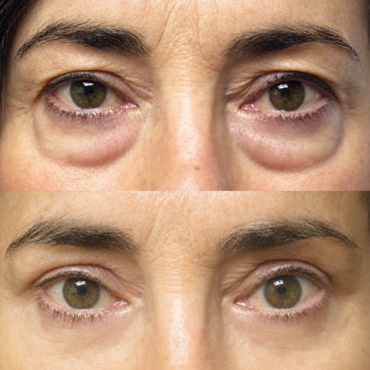 Before and after droopy eyelid surgery results at Memorial Bahçelievler Hospital, eye rejuvenation
