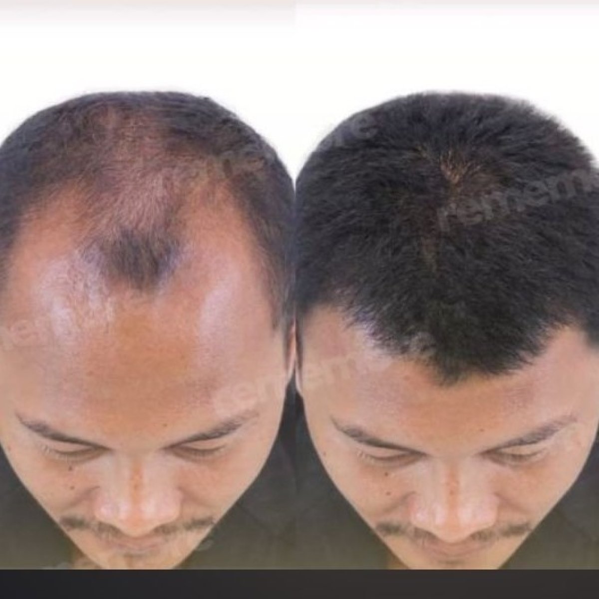 Before and after hair transplant results at Memorial Bahçelievler Hospital, restored hairline
