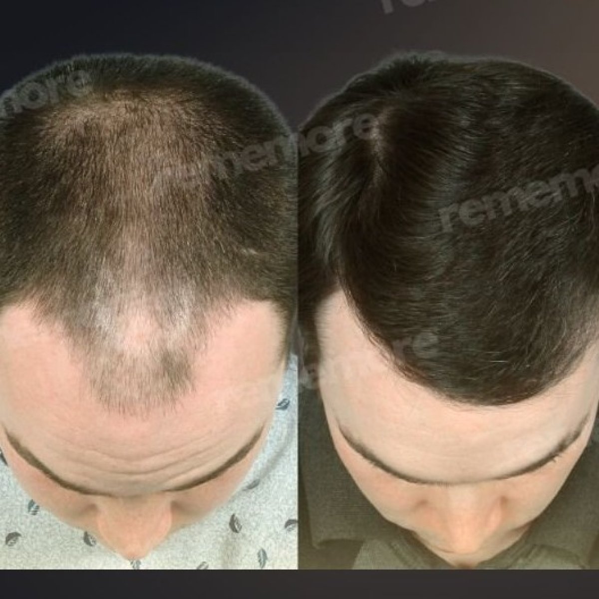نتائج زراعة الشعر قبل وبعد في مستشفى ميموريال باهجيليفلر، استعادة خط الشعر