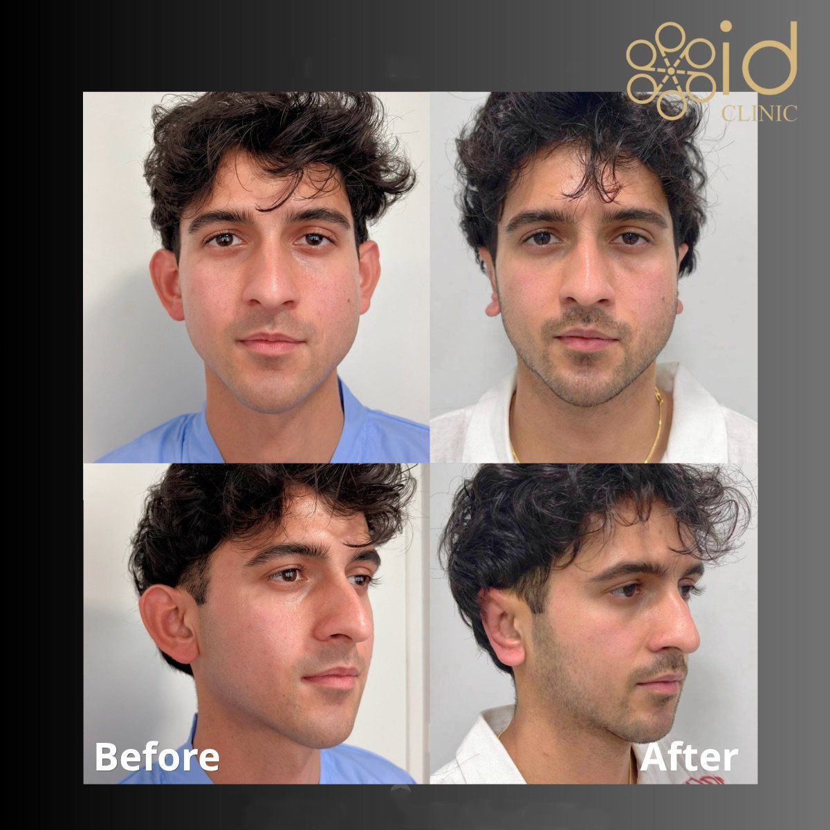 Resultados de otoplastia antes y después en ID Clinic Bangkok, mejora de forma y simetría