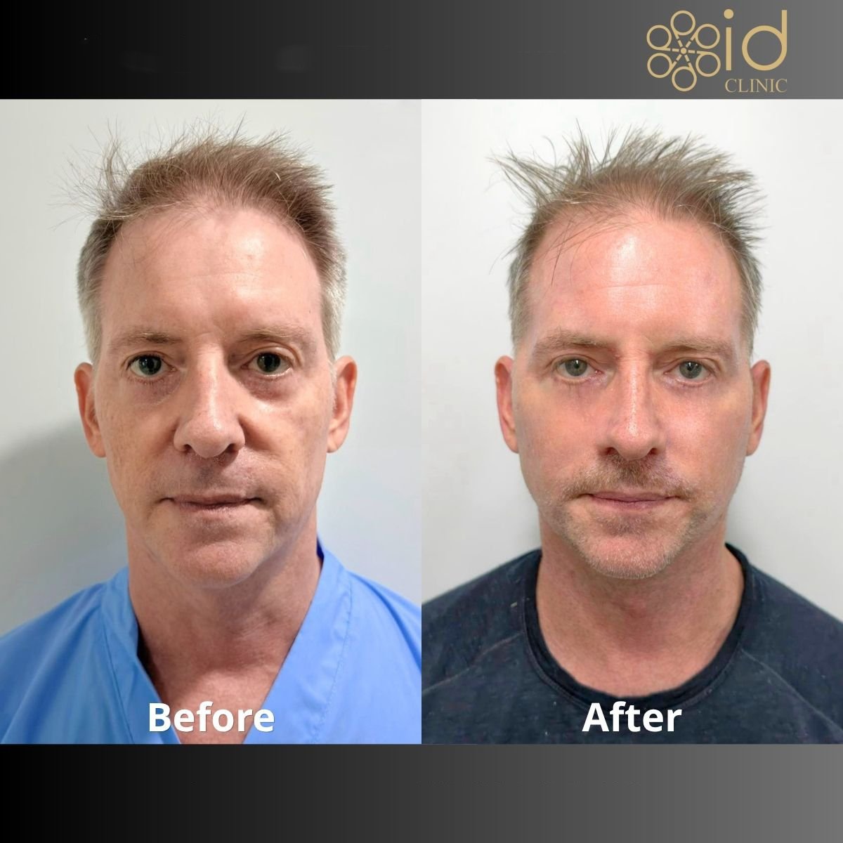 نتائج شد الوجه قبل وبعد في ID Clinic Bangkok، تجديد شباب الوجه لرجل