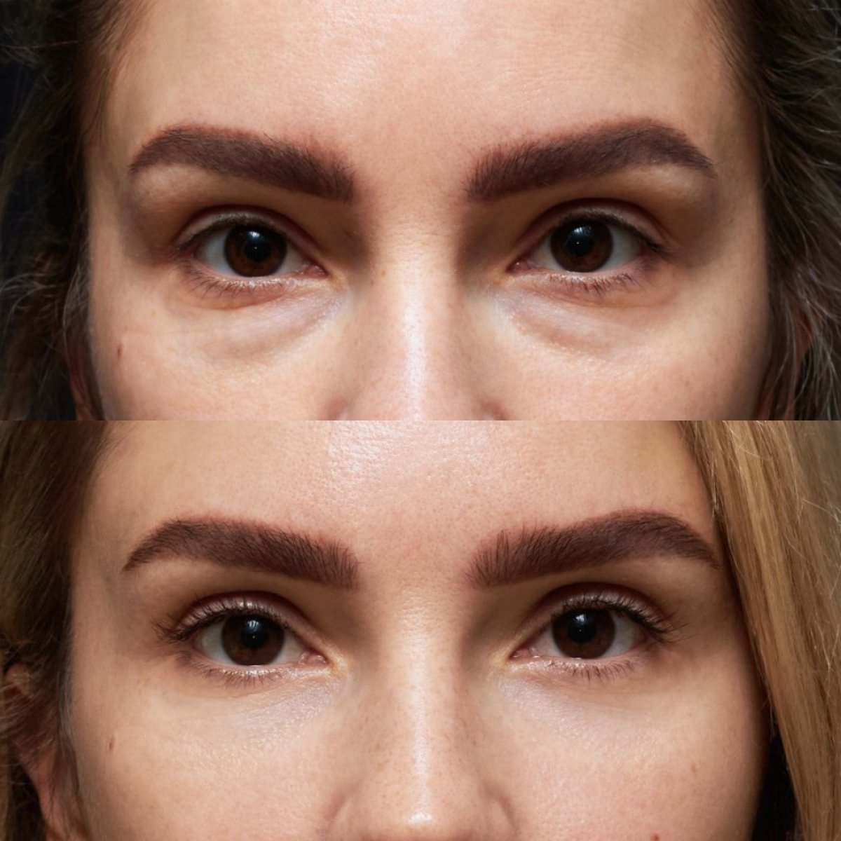 Resultados de blefaroplastia de párpado inferior antes y después en Vidnova Clinic, menos bolsas
