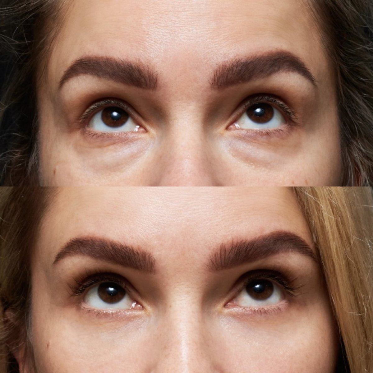 Resultados de blefaroplastia de párpado inferior antes y después en Vidnova Clinic, menos bolsas