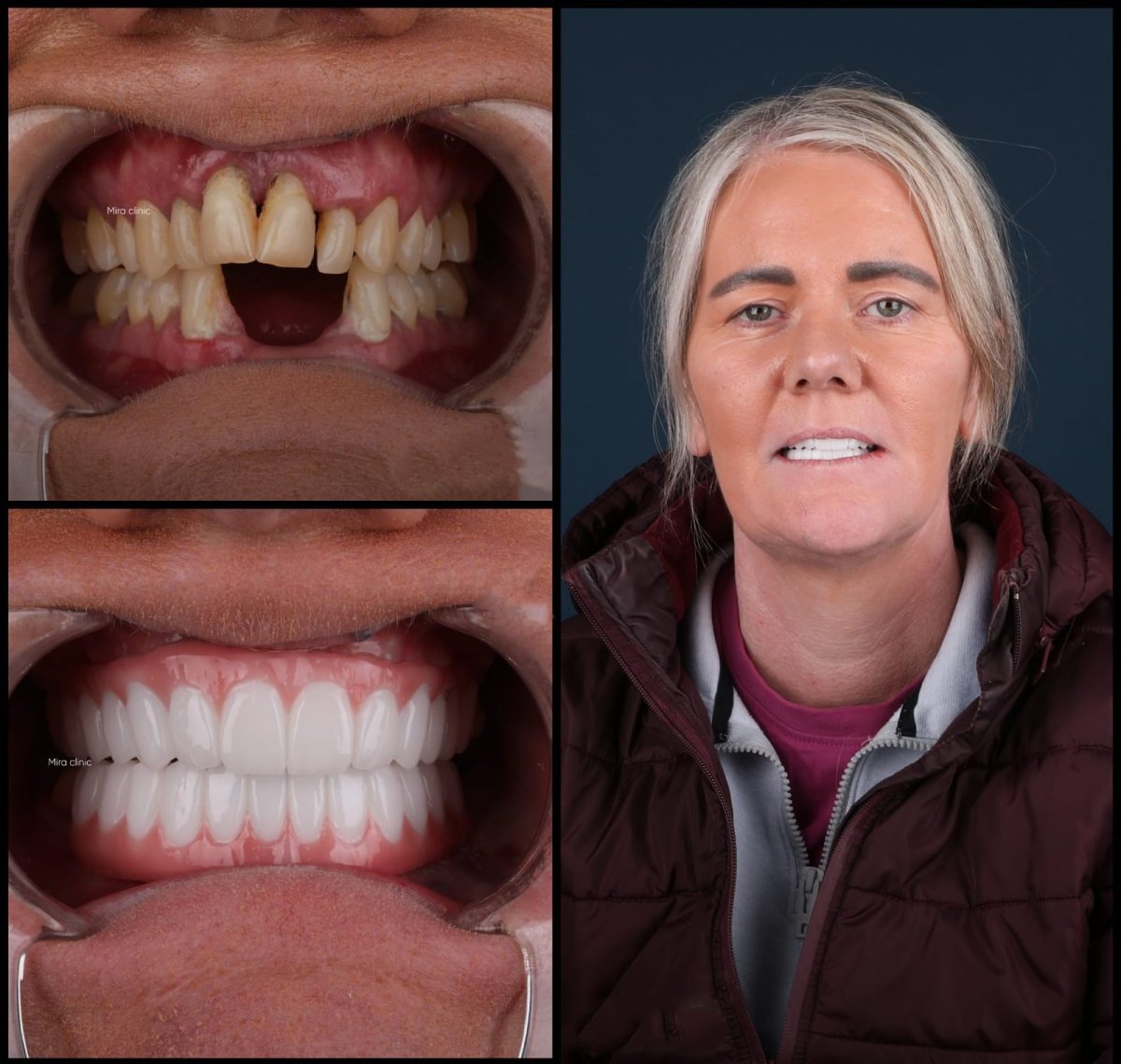 Resultados de implantes dentales All-on-6 antes y después en Mira Clinic, restauración total de la sonrisa