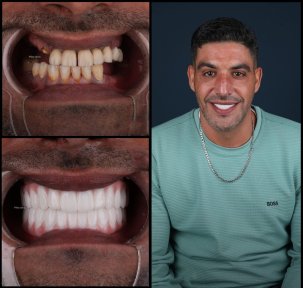 All-on-6 Full Mouth Implant Package with 24 Zirconia Crowns - photo 6