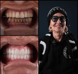 All-on-6 Full Mouth Implant Package with 24 Zirconia Crowns - photo 5