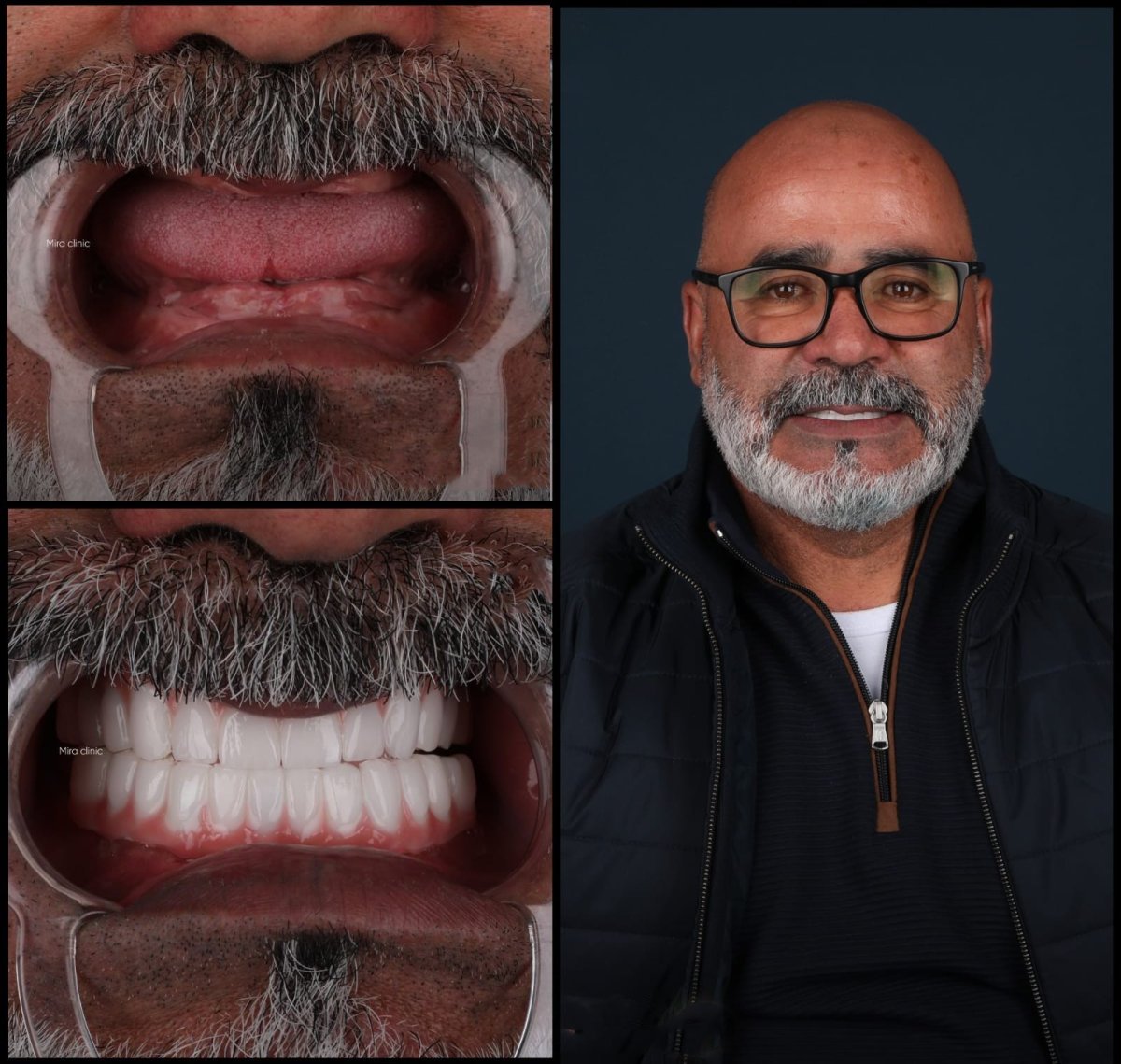 Resultados de implantes dentales All-on-6 antes y después en Mira Clinic, sonrisa restaurada