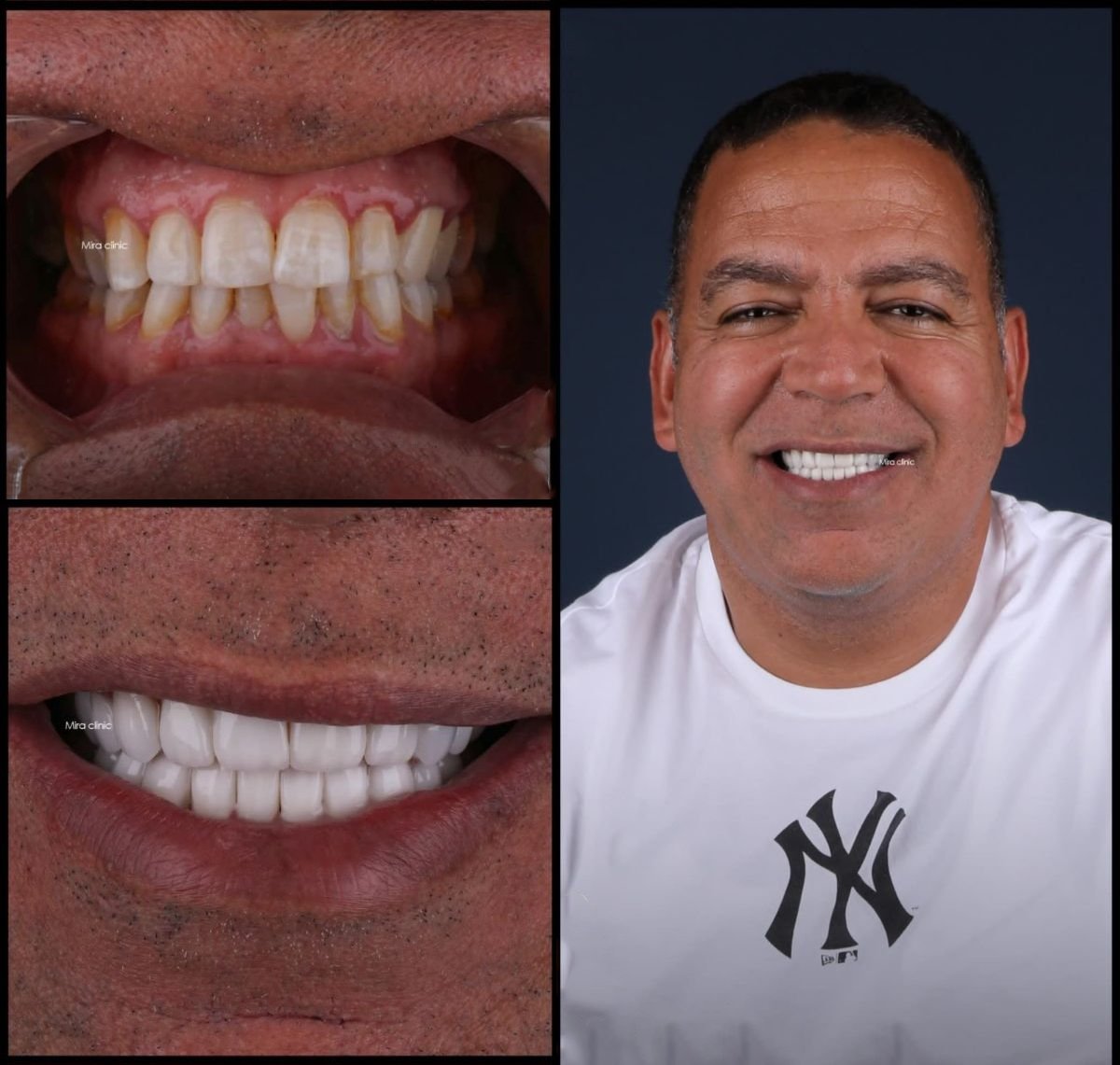 Resultados de carillas dentales antes y después en Mira Clinic, sonrisa mejorada y dientes blancos