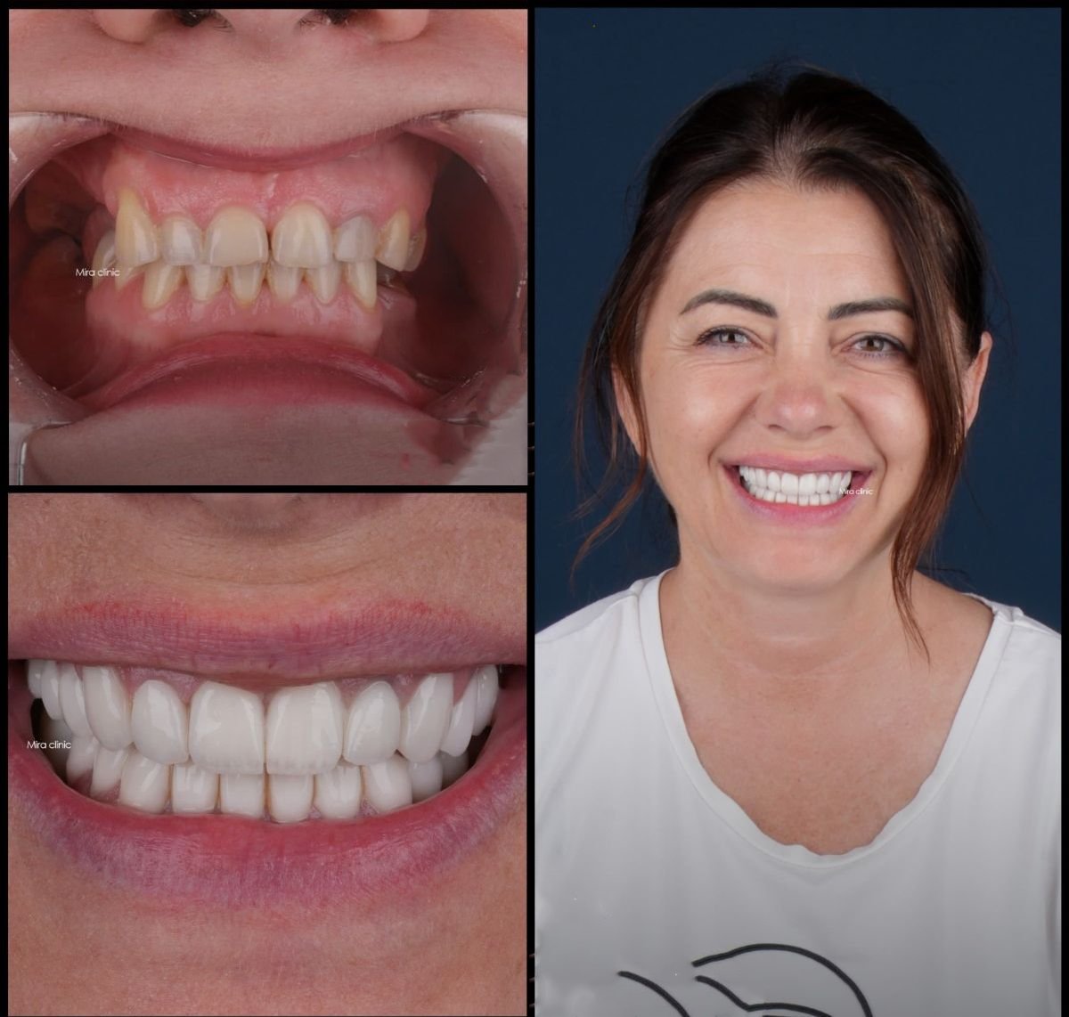 Resultado antes y después de carillas dentales en Mira Clinic, sonrisa natural y renovada