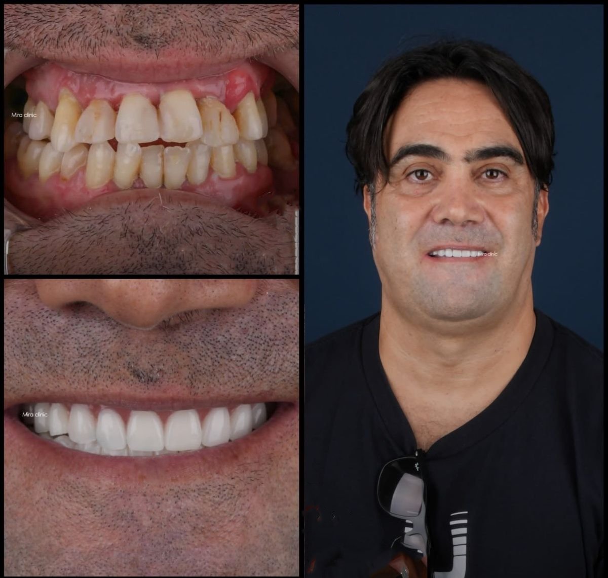 Antes y después de carillas dentales en Mira Clinic: transformación de sonrisa natural