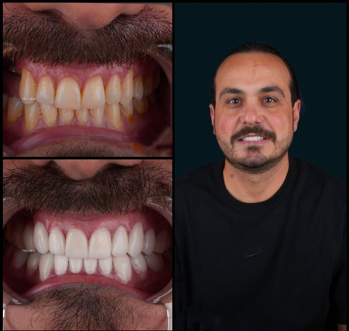 Before and after veneers result at Mira Clinic (Mira Clinic SAĞLIK TURİZM ŞİRKETİ), smile makeover