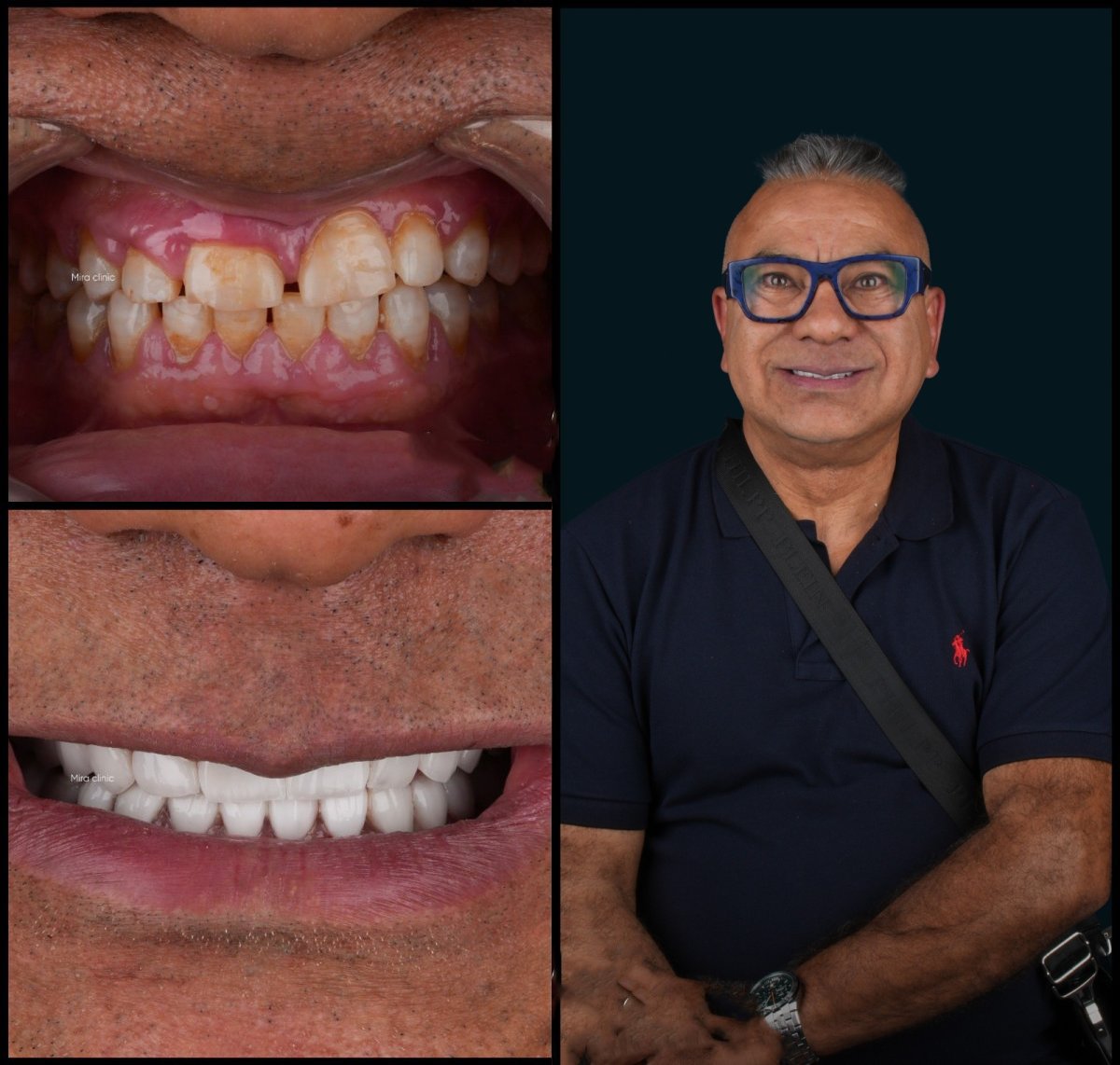 Resultados de antes y después de smile makeover en Mira Clinic, mejor alineación y color dental