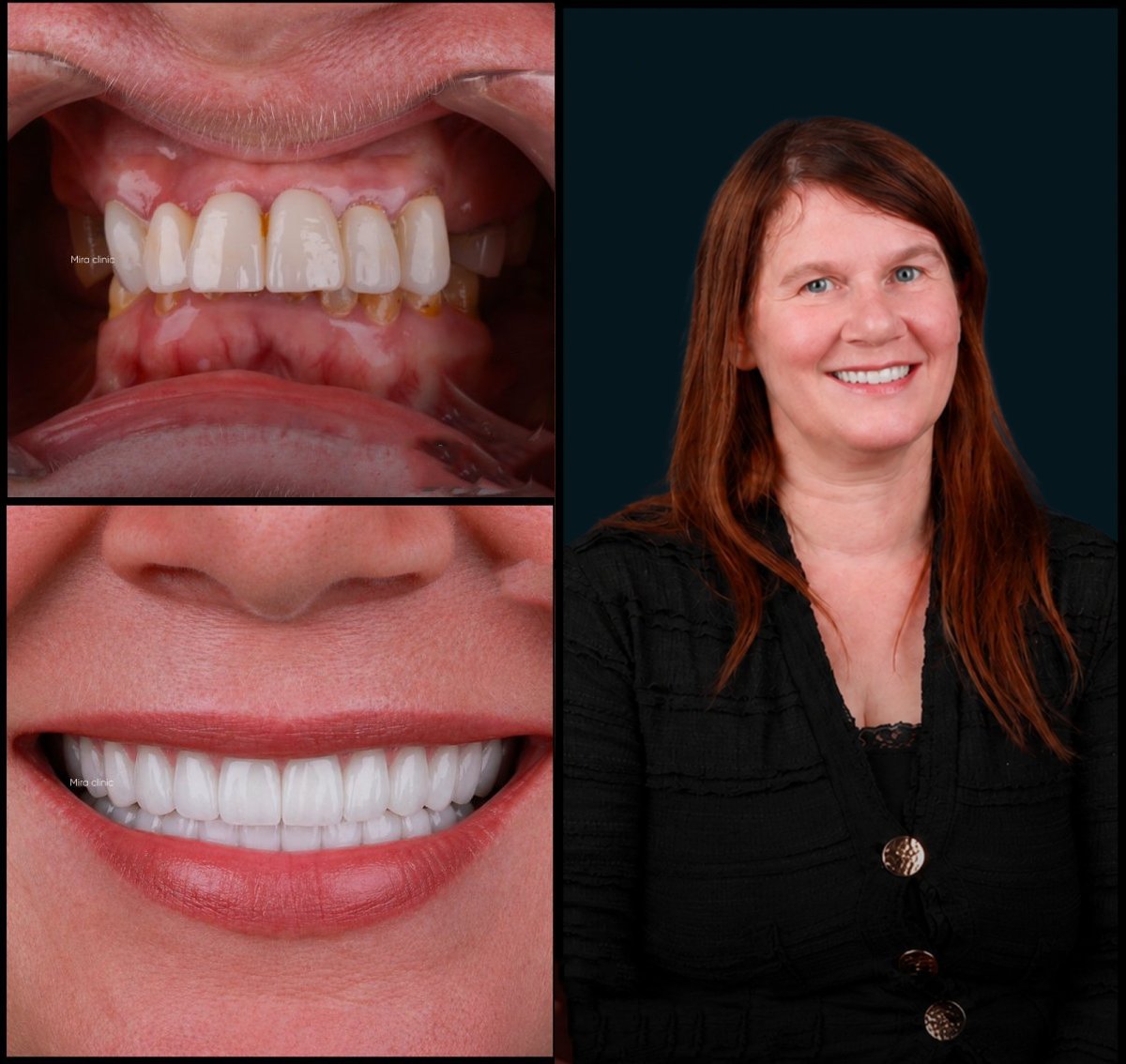 Resultados antes y después de smile makeover en Mira Clinic, carillas dentales naturales