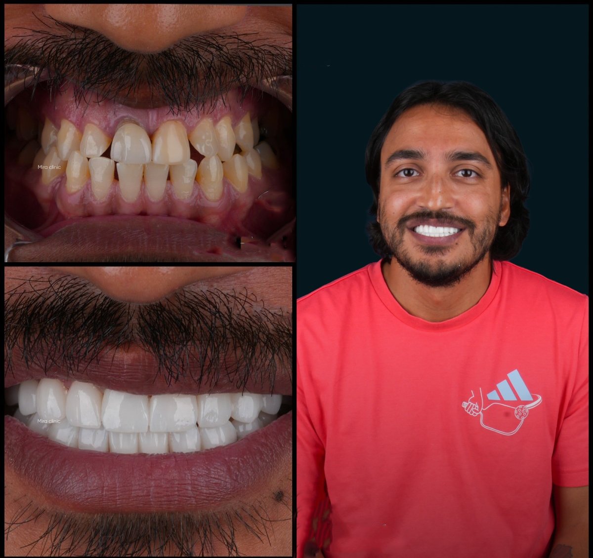 Resultados de cambio de sonrisa antes y después en Mira Clinic, carillas dentales para dientes más blancos