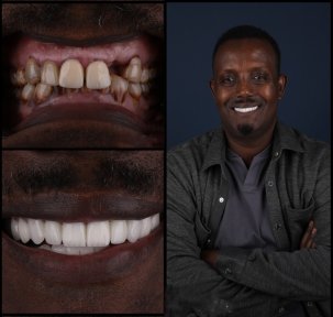 New Smile Package with Zirconia Crowns - photo 6