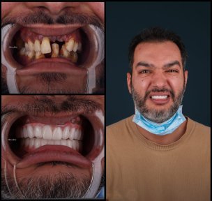 All-on-4 Full Mouth Implant Package with 20 Zirconia Crowns - photo 5