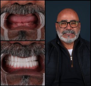 All-on-4 Full Mouth Implant Package with 20 Zirconia Crowns - photo 6