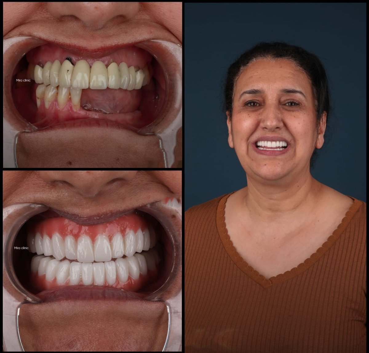 نتائج زراعة الأسنان All-on-4 قبل وبعد في Mira Clinic، استعادة كاملة للابتسامة
