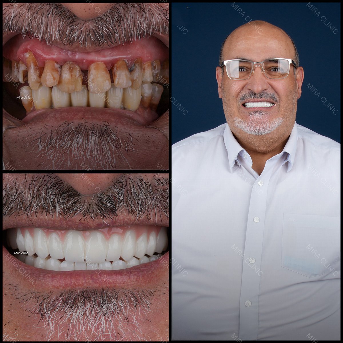 Resultados de antes y después de smile makeover en Mira Clinic, restauración dental y carillas