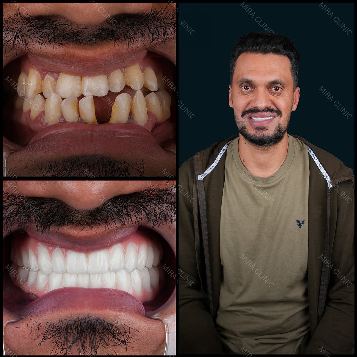 نتائج قبل وبعد تجميل الابتسامة في Mira Clinic، قشور الأسنان لتحسين ترتيب الأسنان