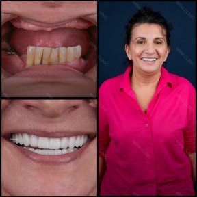 New Smile Package with Zirconia Crowns - photo 4