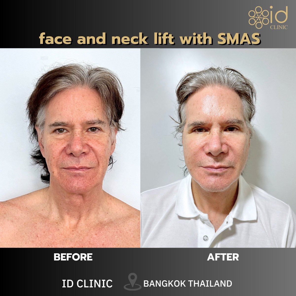 Before and after facelift and neck lift with SMAS at ID Clinic Bangkok, visible rejuvenation result