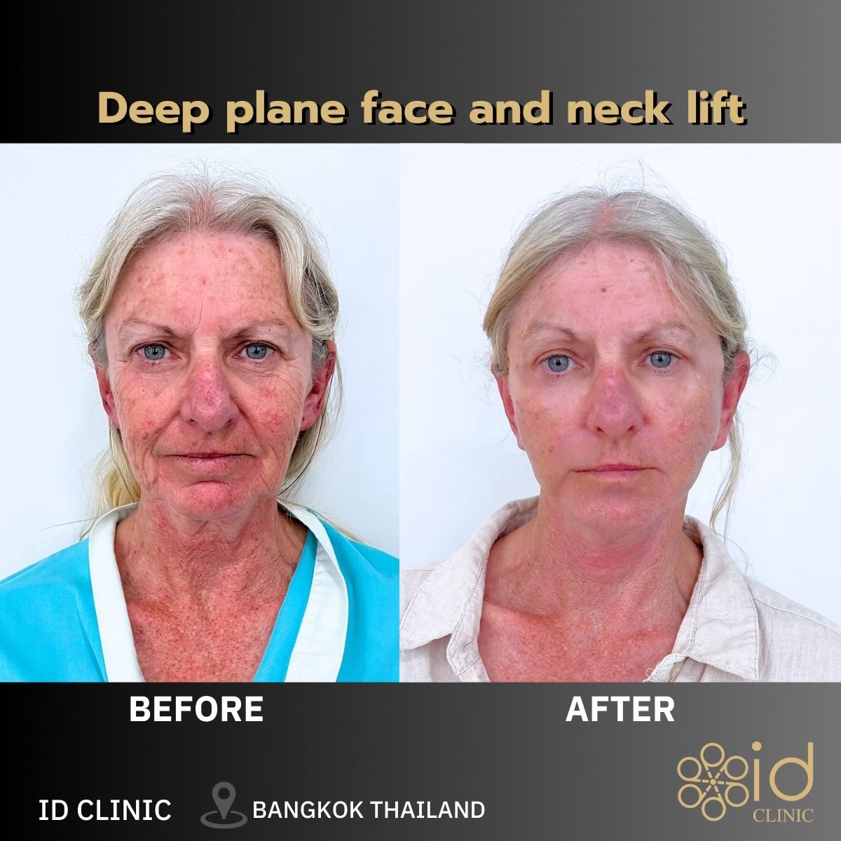 Результаты до и после глубокого SMAS-лифтинга лица и шеи в ID Clinic Bangkok
