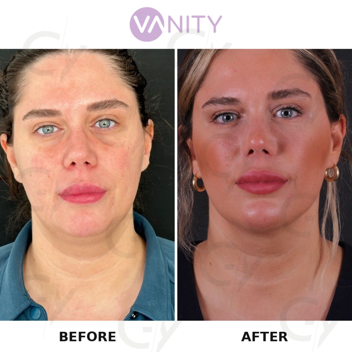 Résultats avant et après liposuccion du menton chez VANITY COSMETIC SURGERY HOSPITAL, mâchoire définie