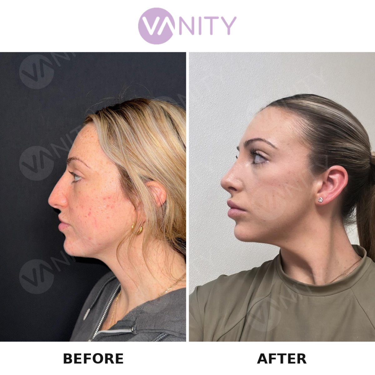 نتائج عملية تجميل الأنف قبل وبعد في VANITY COSMETIC SURGERY HOSPITAL، إعادة تشكيل الأنف