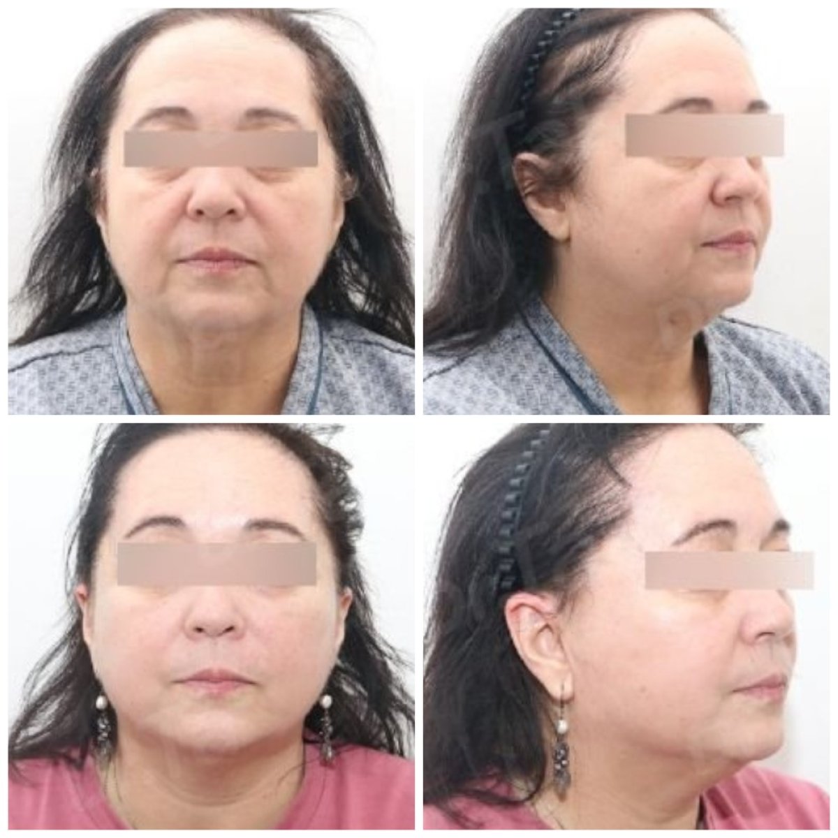Before and after mini facelift results at Dr. Tak Plastic Surgery, visible facial rejuvenation