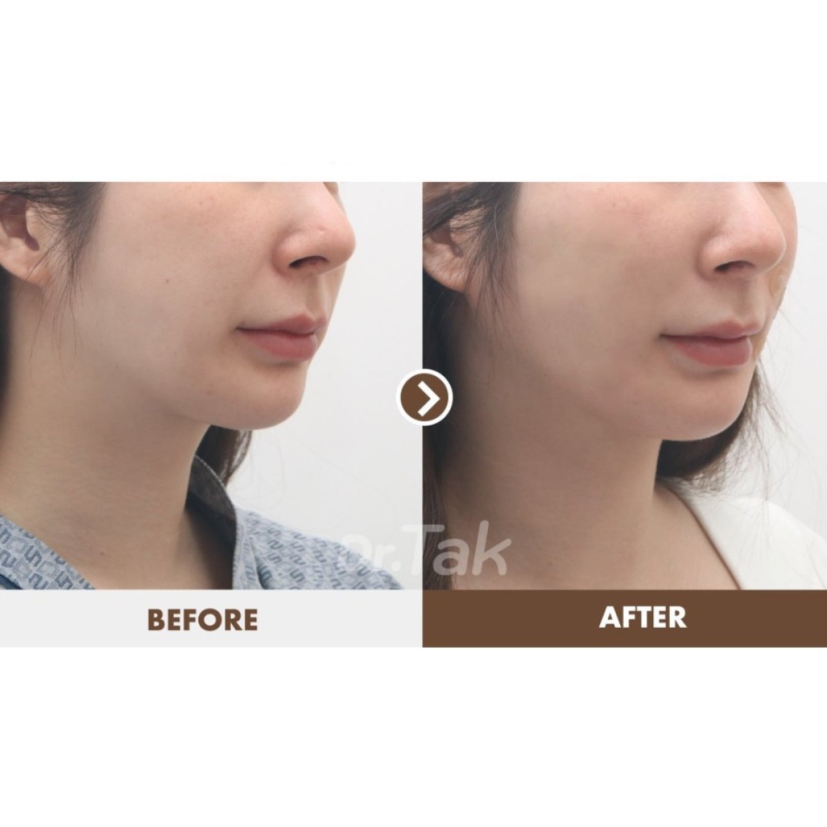 نتائج شد الوجه المصغر قبل وبعد في عيادة Dr. Tak Plastic Surgery، تحسين خط الفك