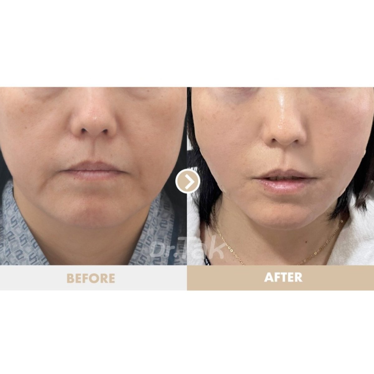 Resultados de minilifting facial antes y después en Dr. Tak Plastic Surgery, rejuvenecimiento facial