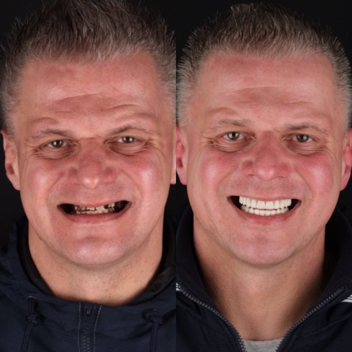 نتائج قبل وبعد تركيب طقم الأسنان في RIKOTA Dental Clinic – استعادة الابتسامة بالكامل