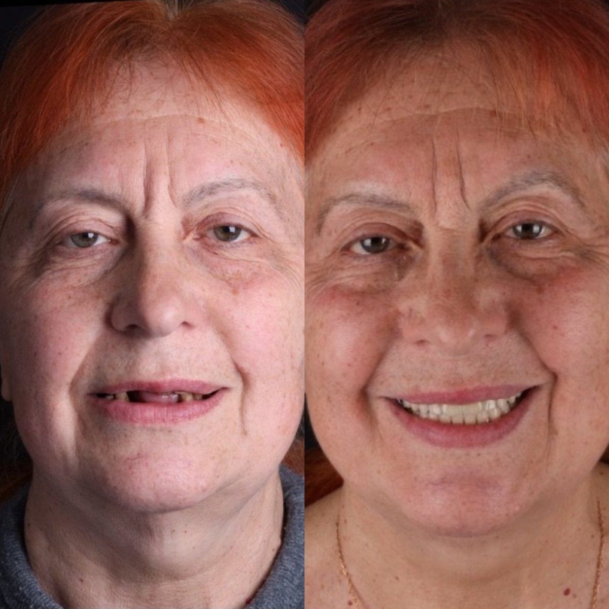 Before and after dental implant results at RIKOTA Dental Clinic – restored smile transformation