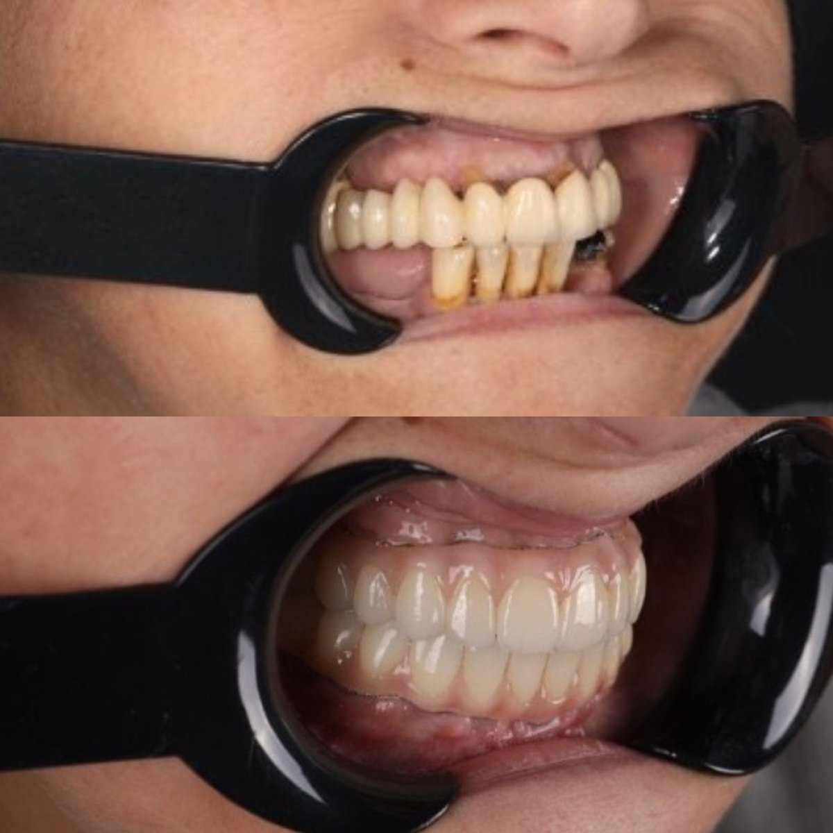 نتائج قبل وبعد زراعة الأسنان في RIKOTA Dental Clinic – ابتسامة طبيعية مستعادة