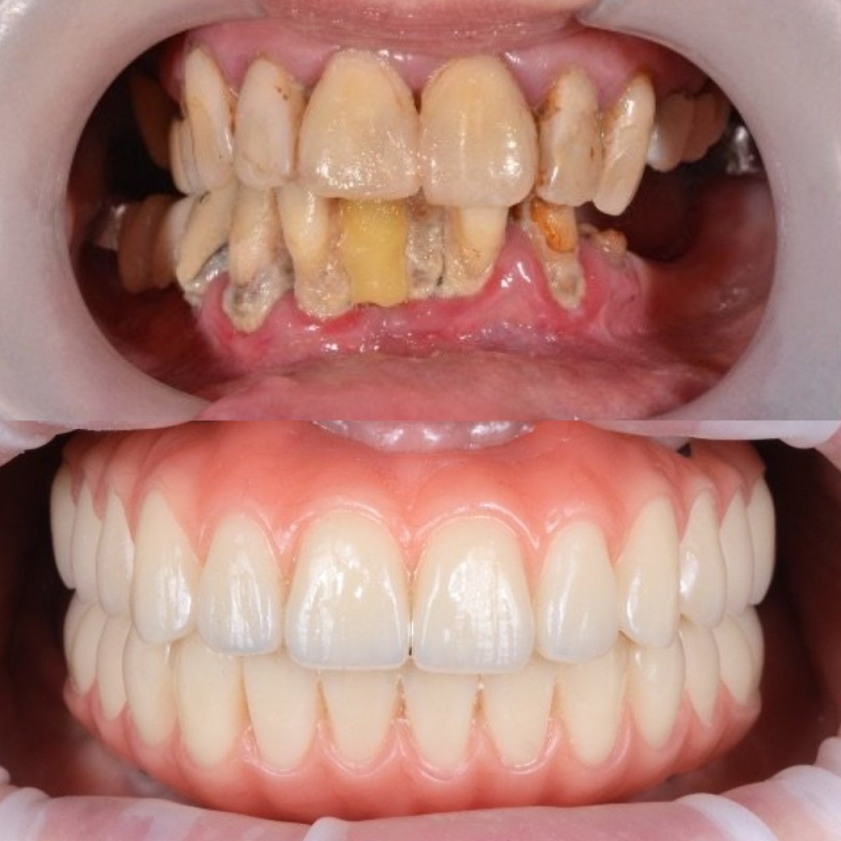 Before and after All-on-4 dental implants result at RIKOTA Dental Clinic, full smile restoration