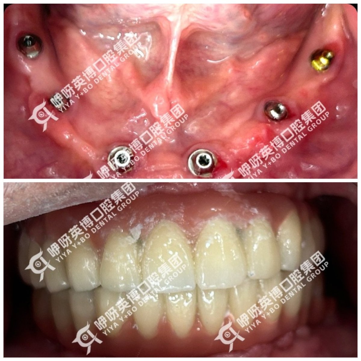 Before and after dental implant results at Wuhan Yiya Simei Dental Hospital, restored full smile