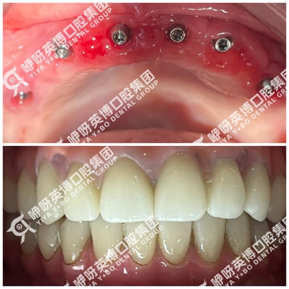 Результати до і після імплантації зубів у Wuhan Yiya Simei Dental Hospital, відновлена посмішка