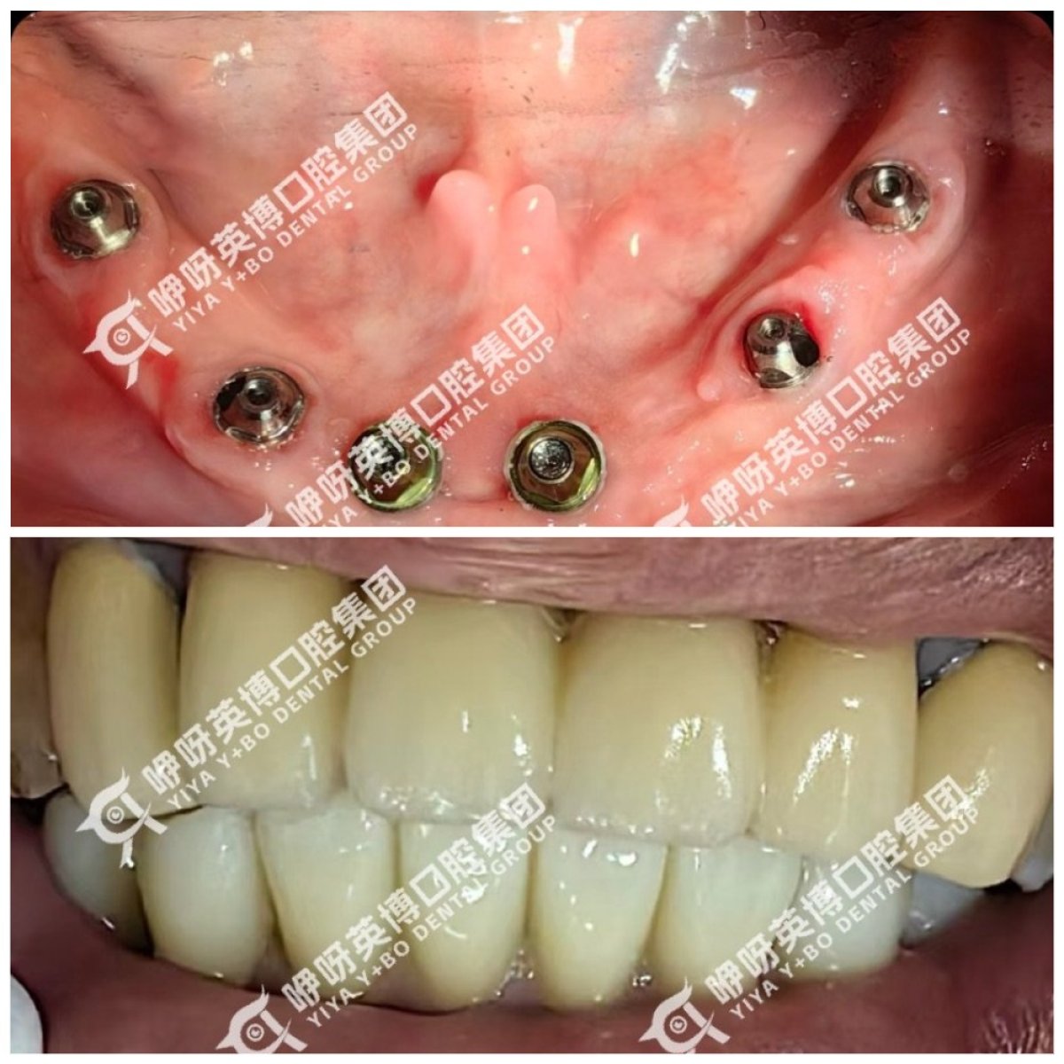 Résultats avant et après implants dentaires à Wuhan Yiya Simei Dental Hospital, sourire restauré
