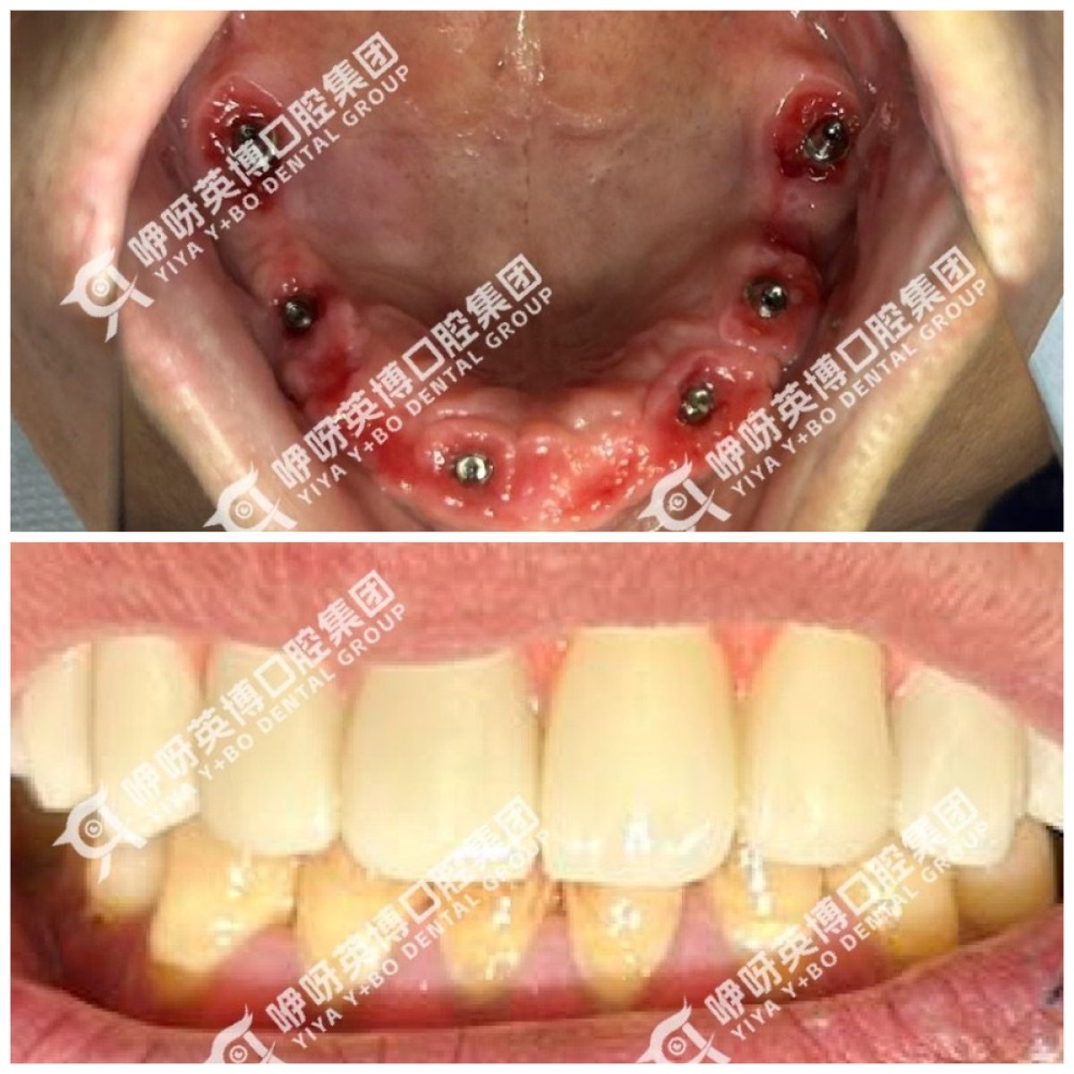 Resultados antes y después de implantes dentales en Wuhan Yiya Simei Dental Hospital, sonrisa restaurada