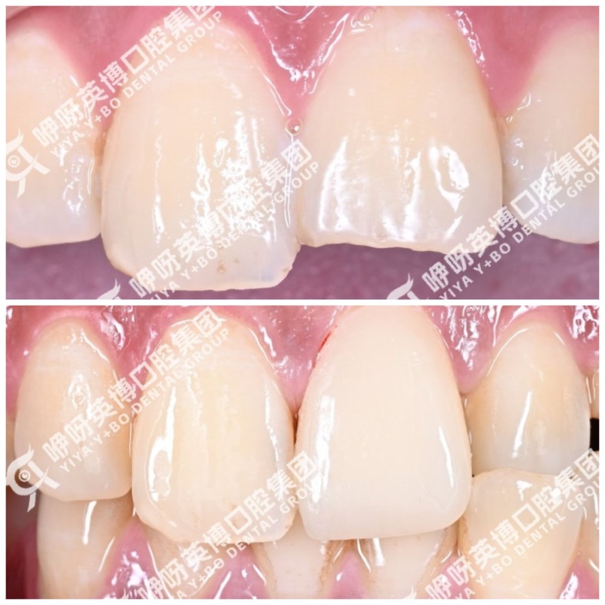 Результат до та після встановлення Emax-вінірів у Wuhan Yiya Simei Dental Hospital, посмішка
