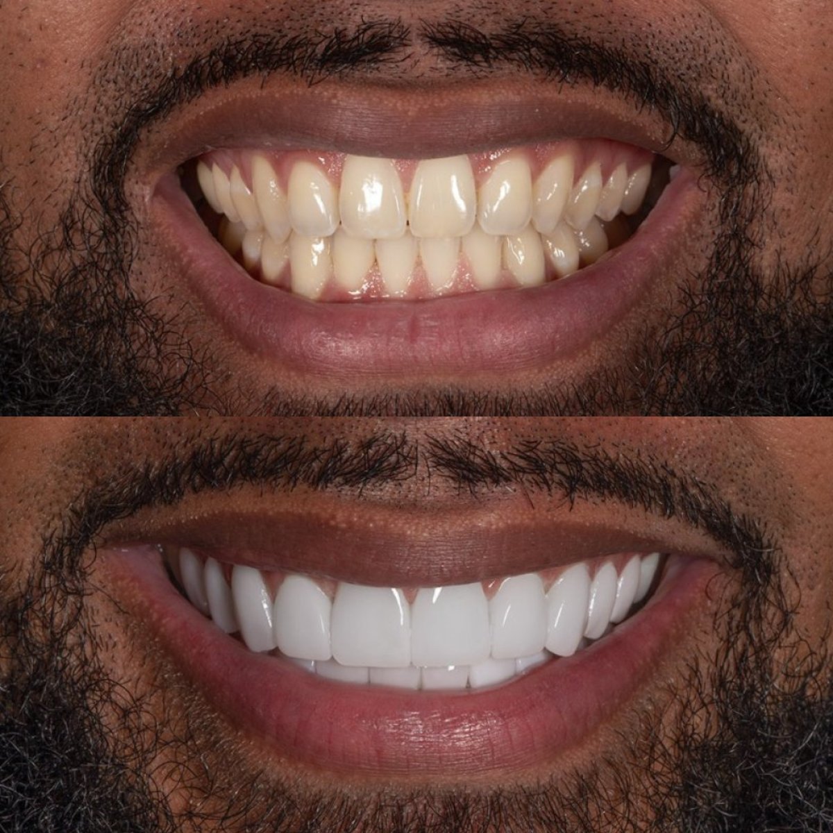 До та після встановлення вінірів у Darya Dental Turkey, перетворення посмішки, білі зуби